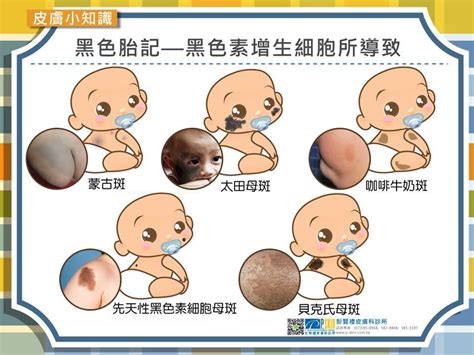 後背有胎記|寶寶胎記長在了什麼部位？不同胎記代表不同命運